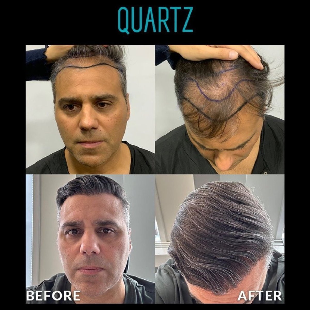 Before and after No Shave Hair Transplant results at Quartz Hospital, restored hairline