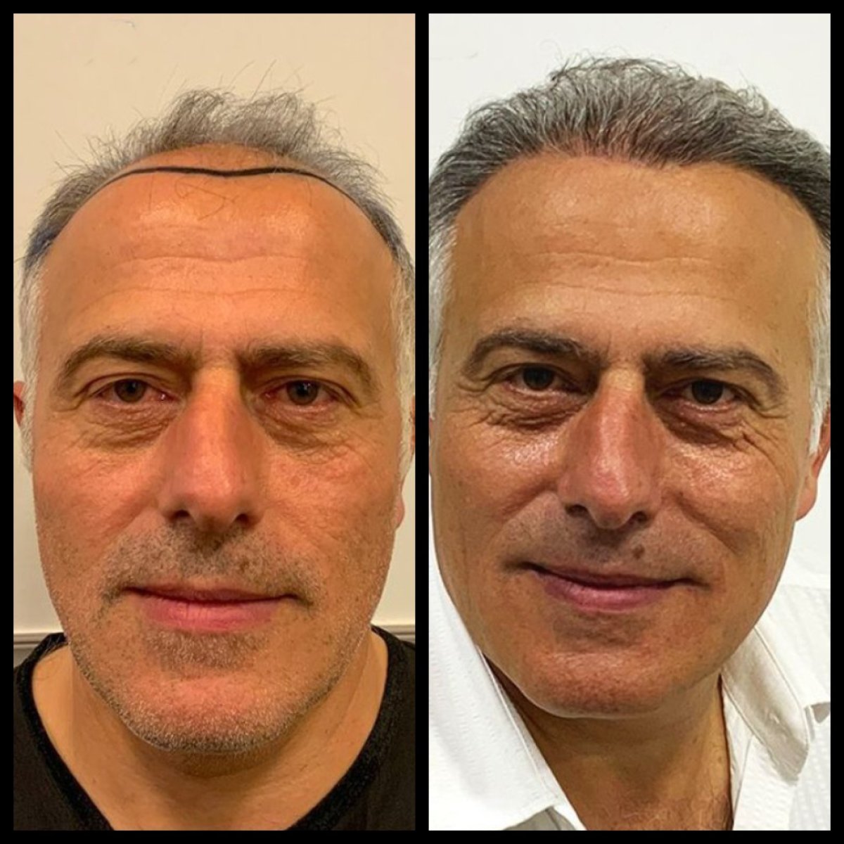 Before and after No Shave Hair Transplant result at Quartz Hospital, improved hairline