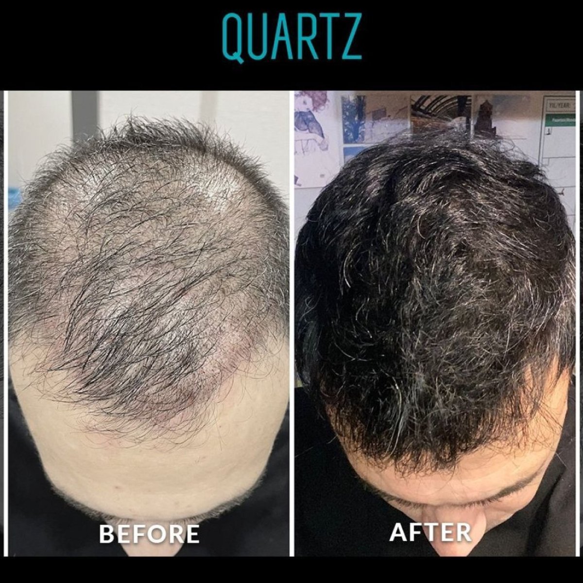 Before and after No Shave Hair Transplant results at Quartz Hospital, fuller hair restoration