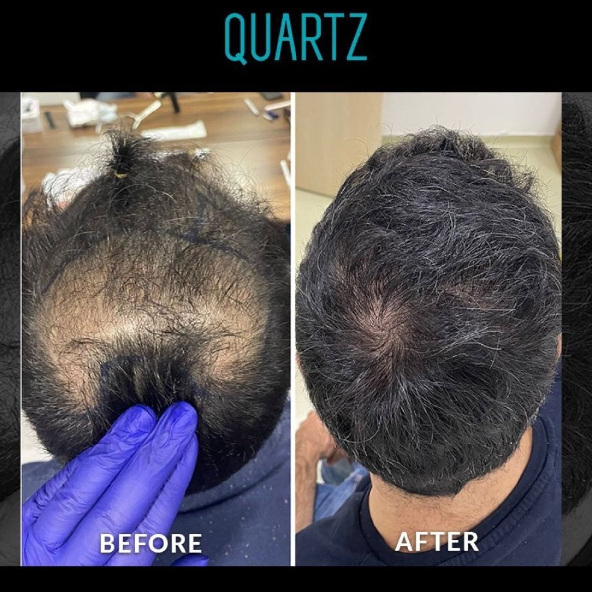 Before and after No Shave Hair Transplant at Quartz Hospital – visible hair density result