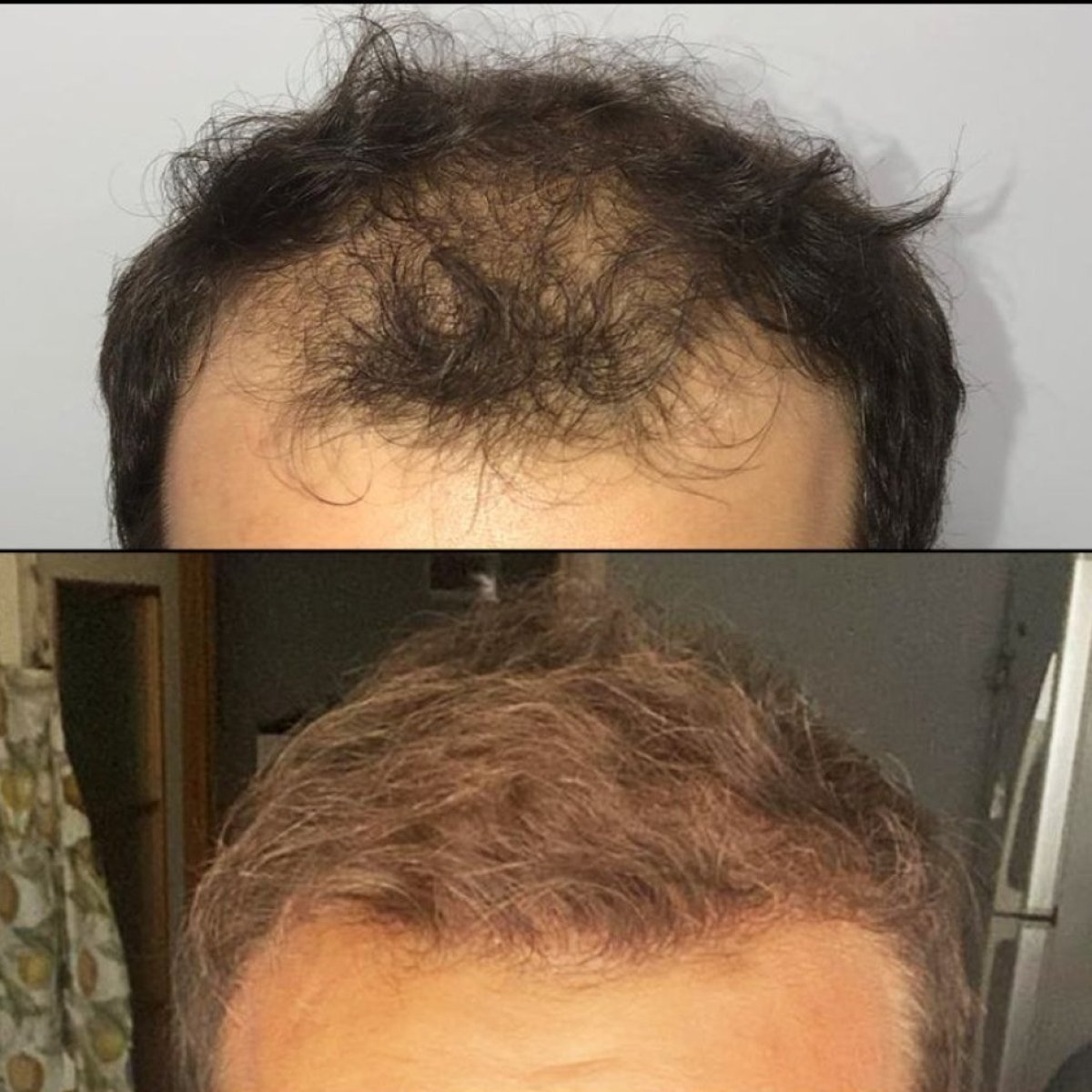 Before and after No Shave Hair Transplant results at Quartz Hospital, improved hair density