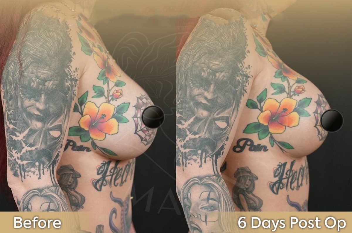 Breast implant revision before and after results at Dr. Safa Manav Clinic, 6 days post-op