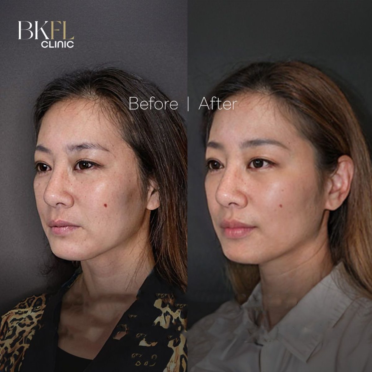 Результаты до и после подтяжки лица AccuTite в BKFL Clinic, улучшение контура лица