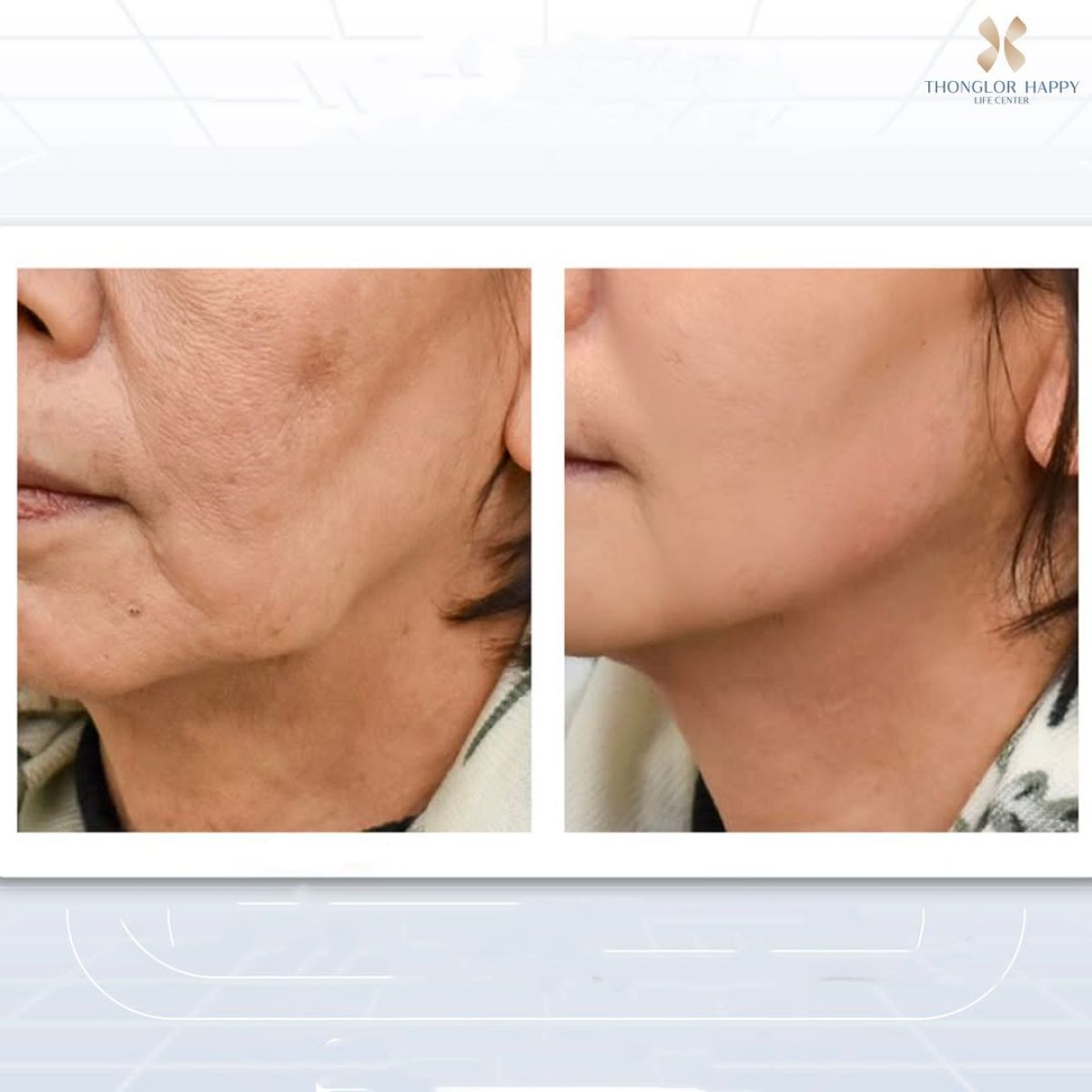 Resultados antes y después de Morpheus8 en BKFL Clinic, mayor firmeza facial