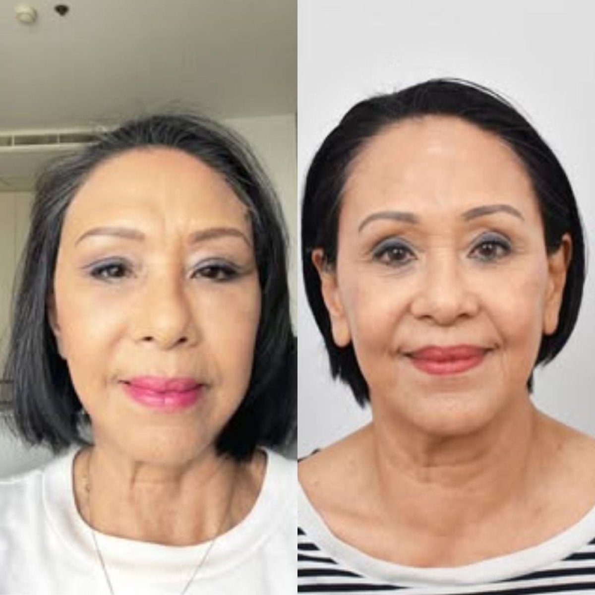 Resultados antes y después de Morpheus8 para reafirmar la piel facial en BKFL Clinic