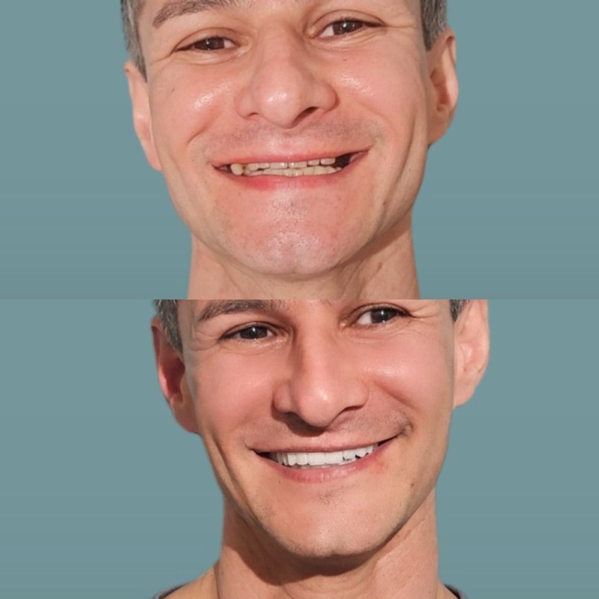 Antes y después de carillas dentales en KLİNİKEN: transformación de sonrisa natural