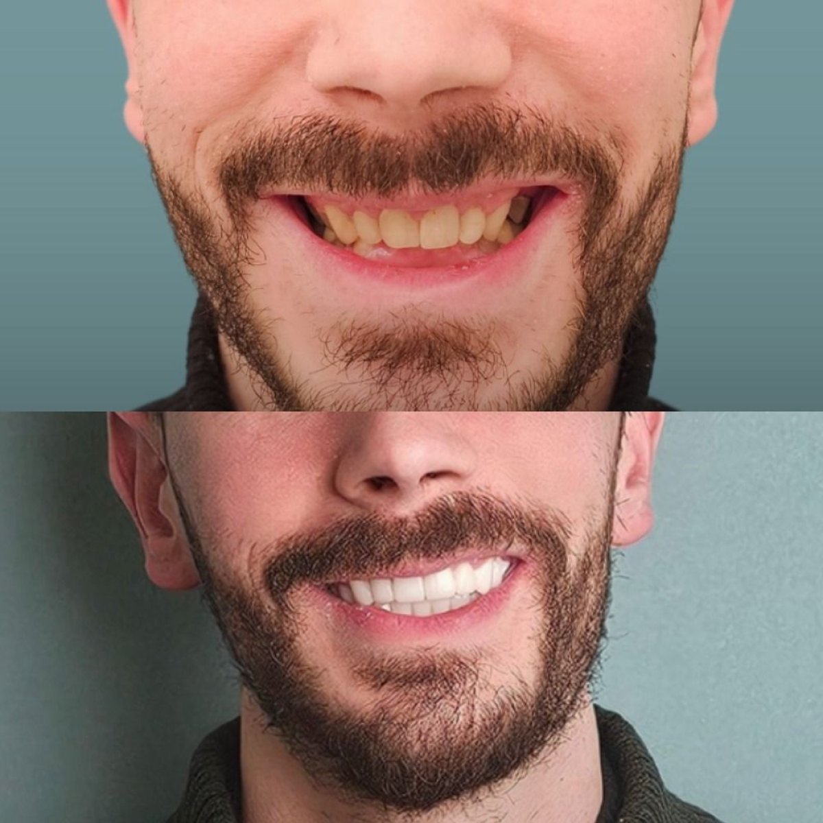 Resultados de blanqueamiento dental antes y después en KLİNİKEN, sonrisa más brillante