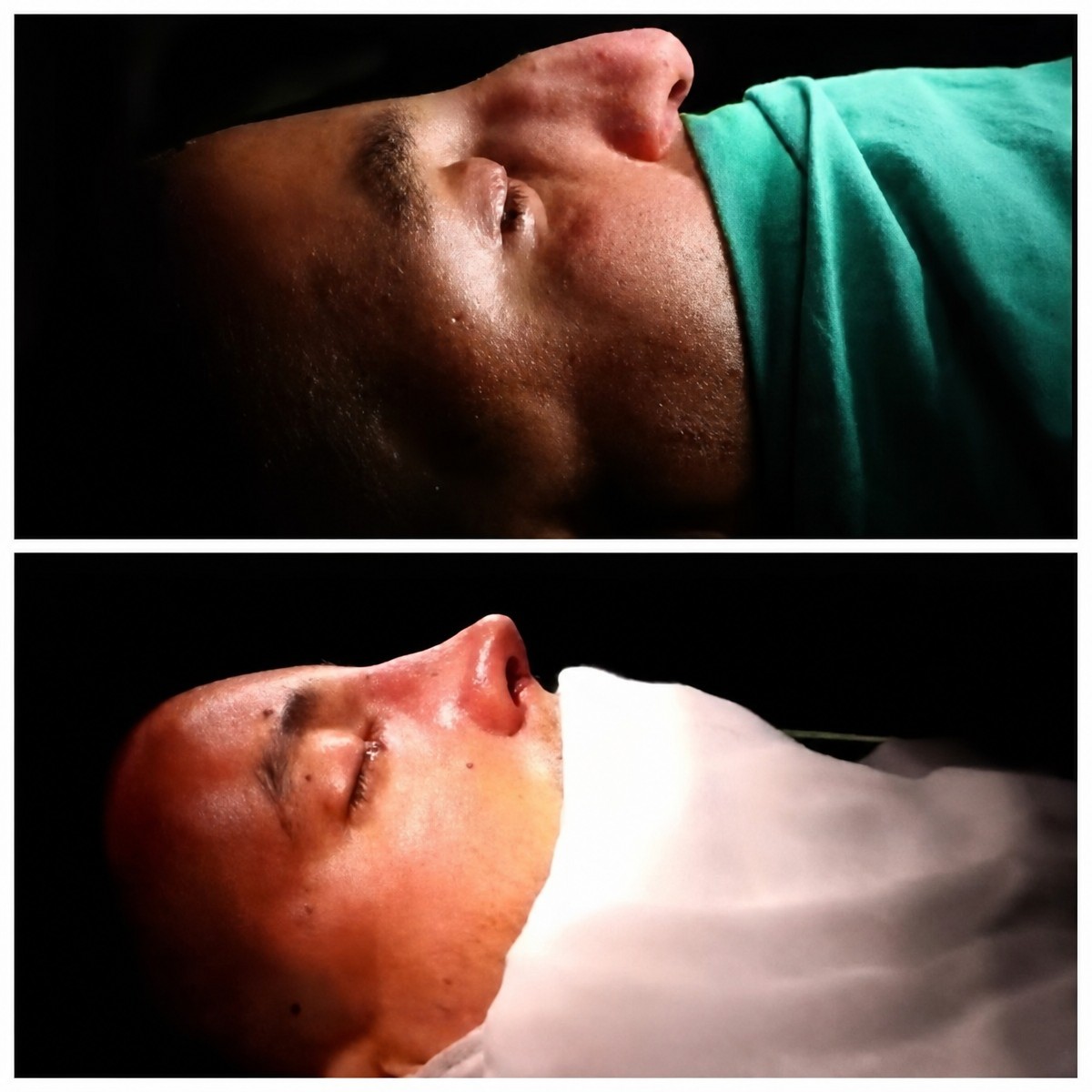 Before and after tip rhinoplasty results at Hisar Hospital Intercontinental, nose reshaping