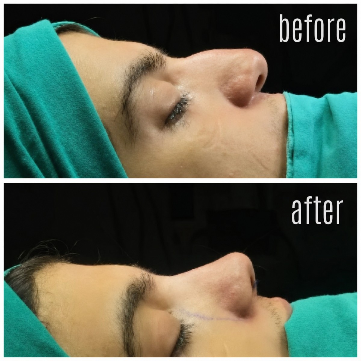 Resultados antes y después de rinoplastia de punta en Hisar Hospital Intercontinental