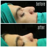 Фото до и после ринопластики кончика носа, доктор Хасан Шахин