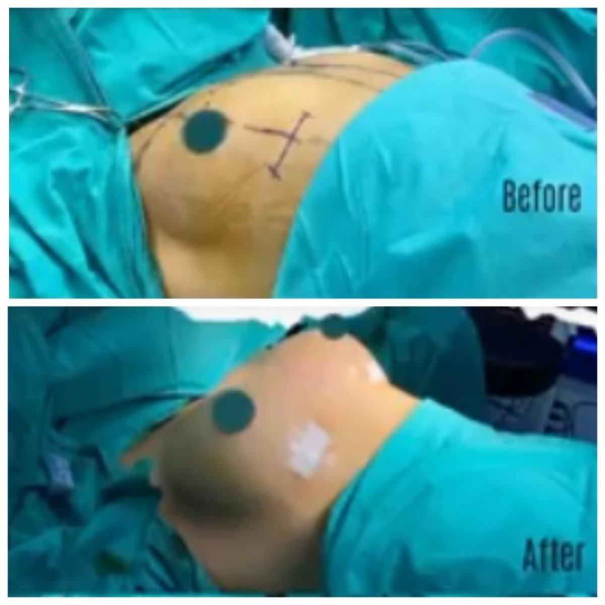Before and after breast reconstruction surgery results at Hisar Hospital Intercontinental