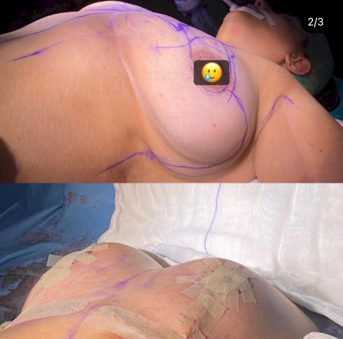 Before and after breast reconstruction surgery results at Hisar Hospital Intercontinental