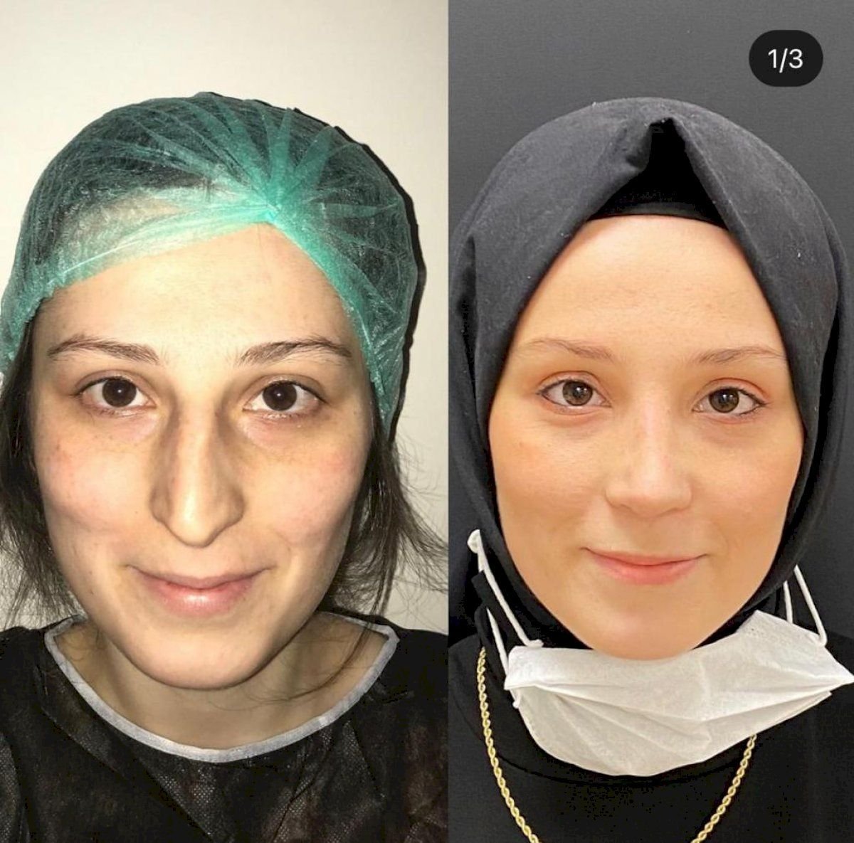 Resultados antes y después de rinoplastia de punta en Hisar Hospital Intercontinental