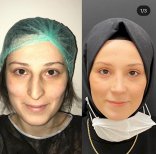 Фото до и после ринопластики кончика носа, доктор Хасан Шахин