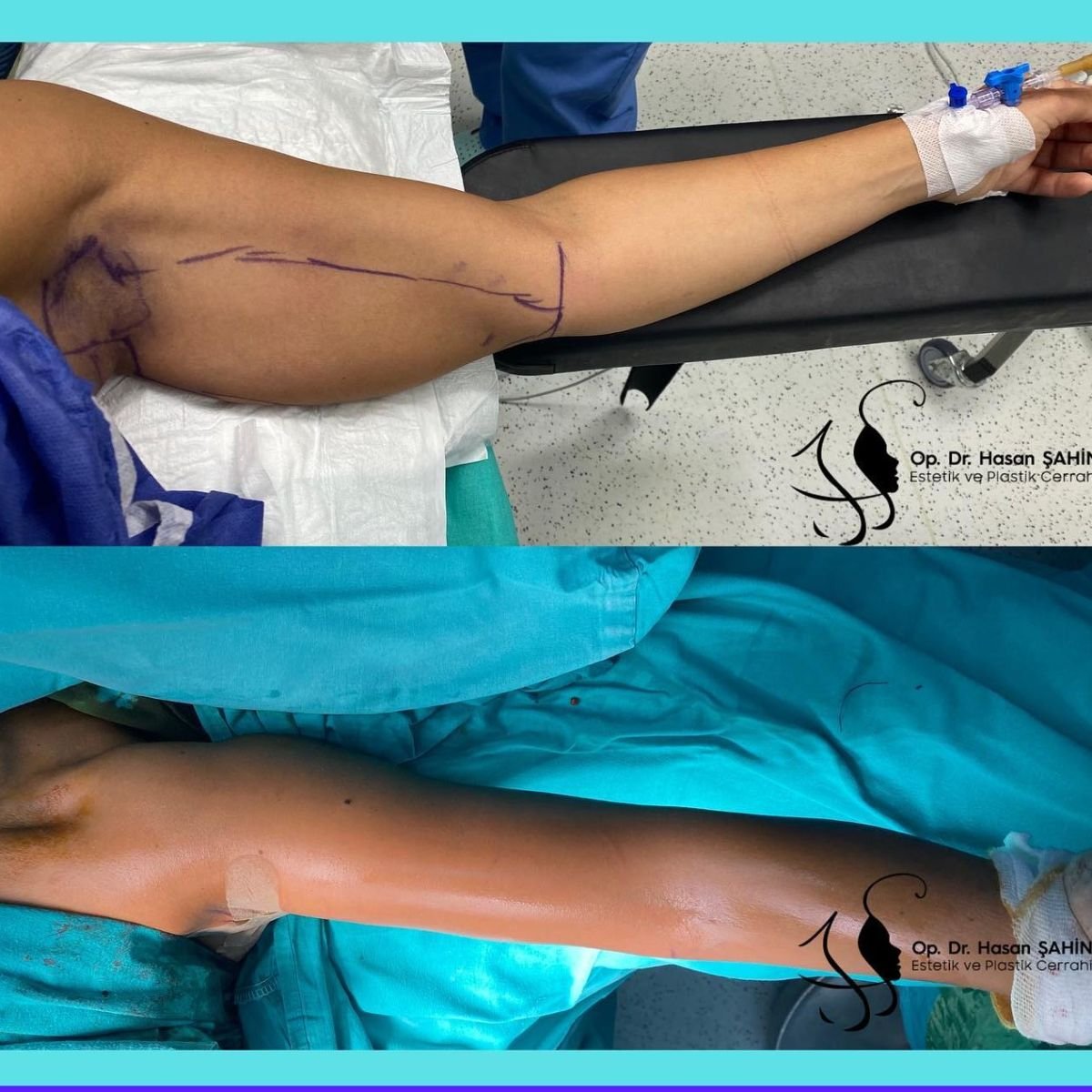 Before and after arm lift results at Hisar Hospital Intercontinental, brachioplasty procedure