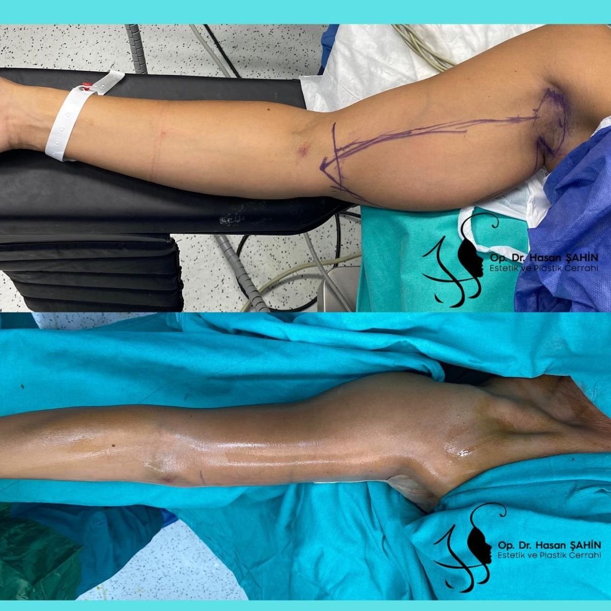 Before and after arm lift (brachioplasty) results at Hisar Hospital Intercontinental