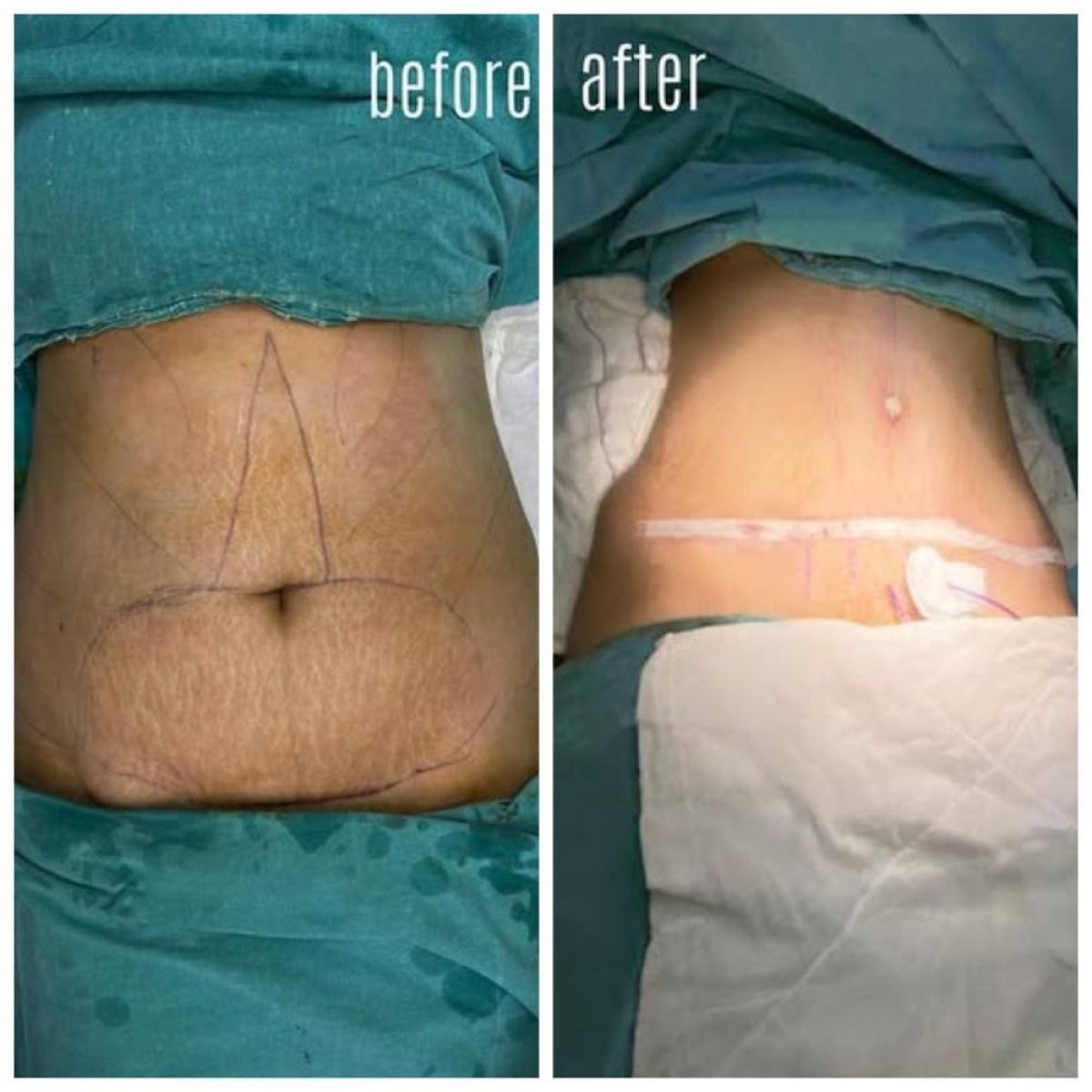 Before and after tummy tuck and liposuction results at Hisar Hospital Intercontinental