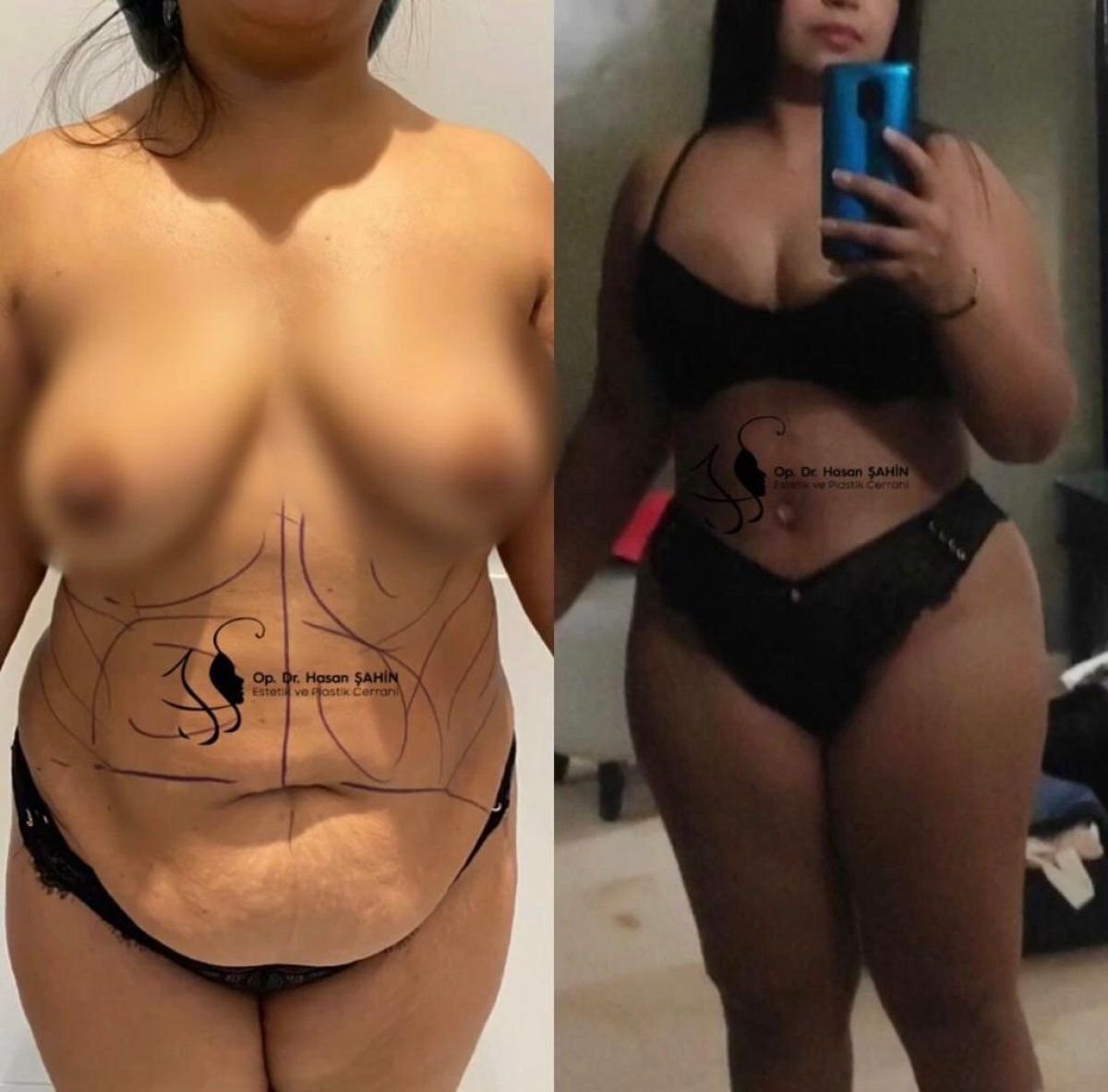 Before and after tummy tuck and liposuction results at Hisar Hospital Intercontinental