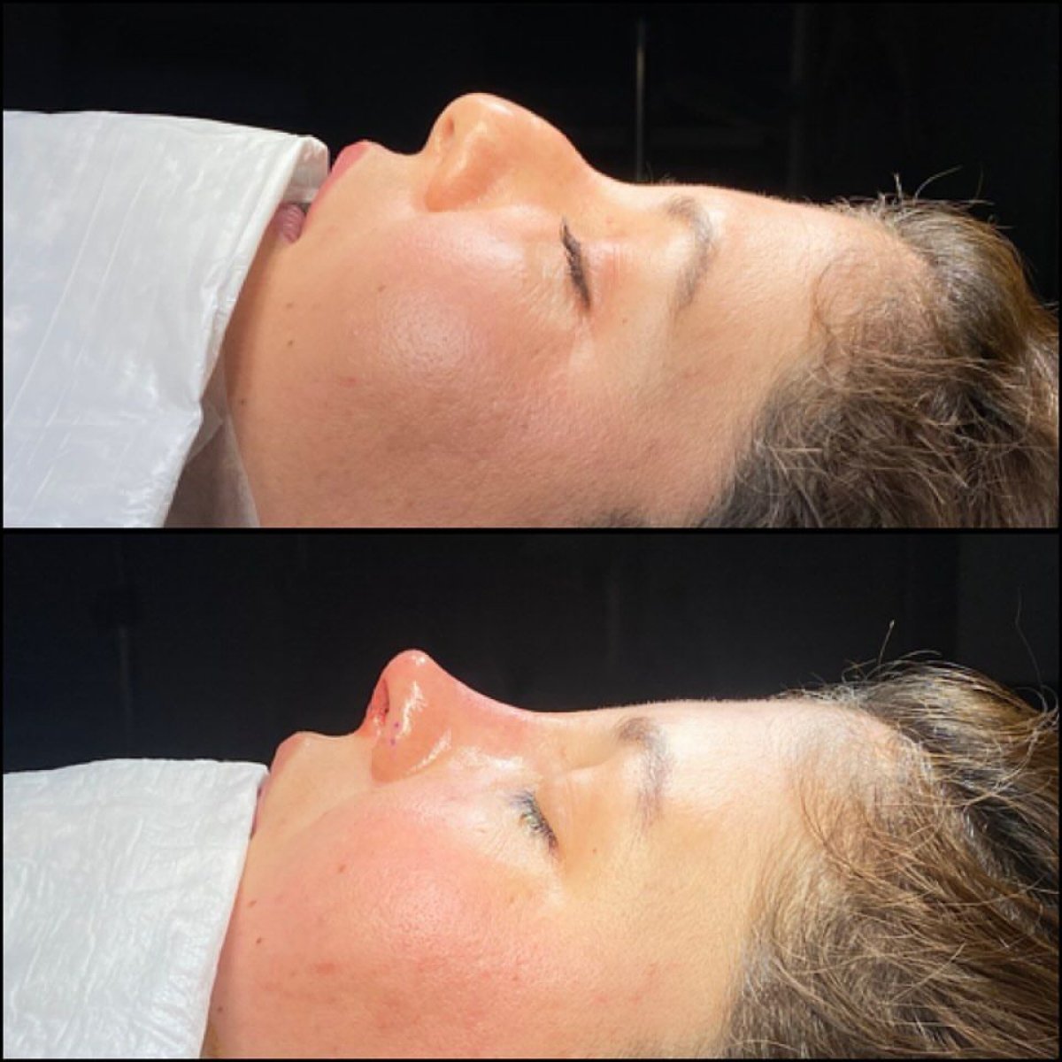 Efekty przed i po septoplastyce w Hisar Hospital Intercontinental, poprawiony profil nosa