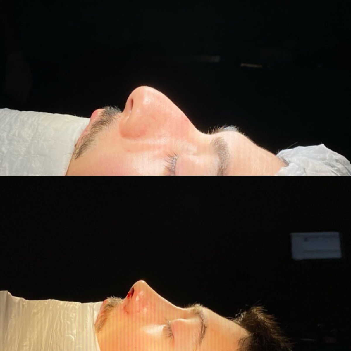Before and after septoplasty results at Hisar Hospital Intercontinental, improved nasal profile