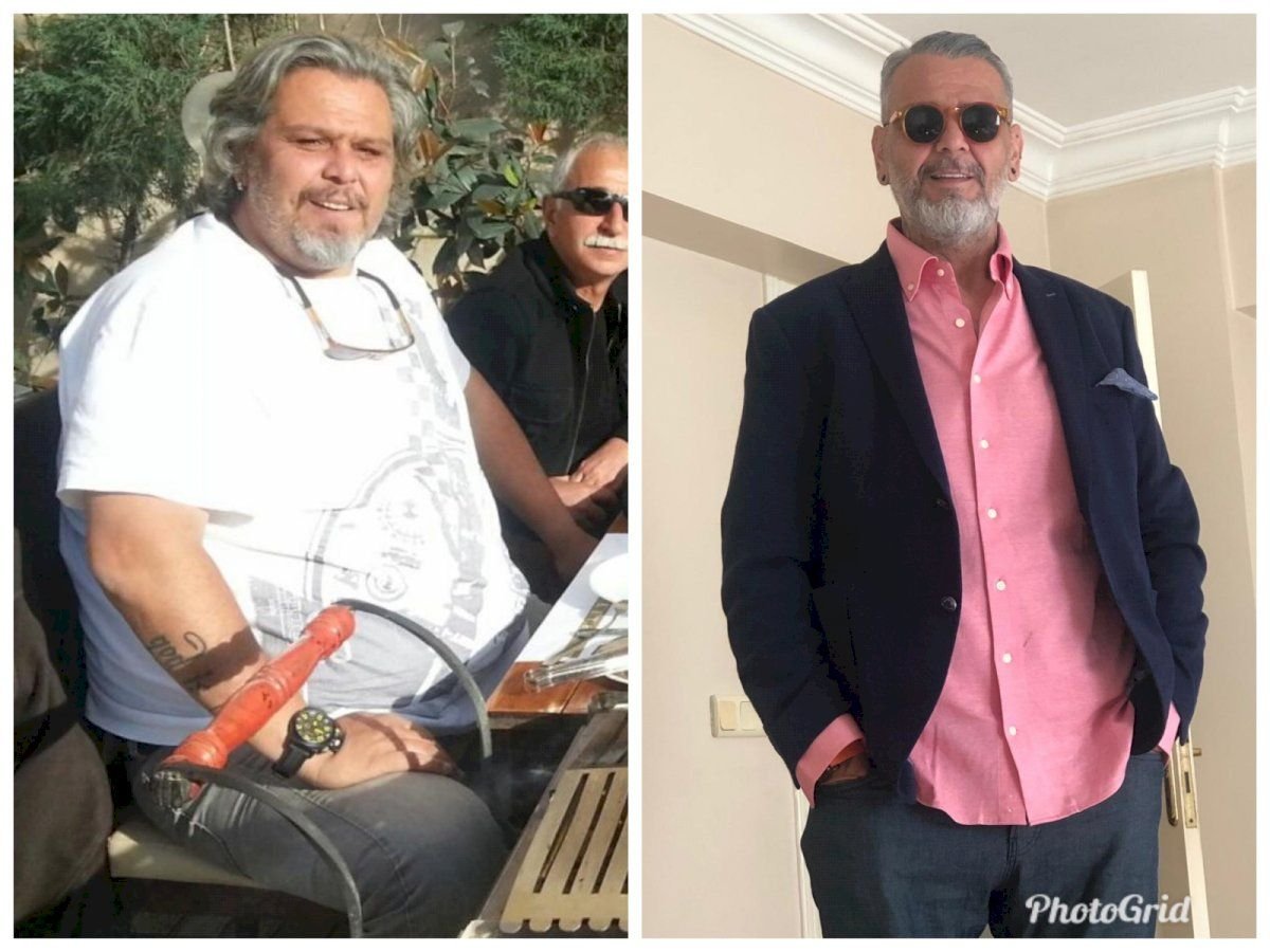 Before and after Da Vinci gastric sleeve surgery result at Hisar Hospital Intercontinental