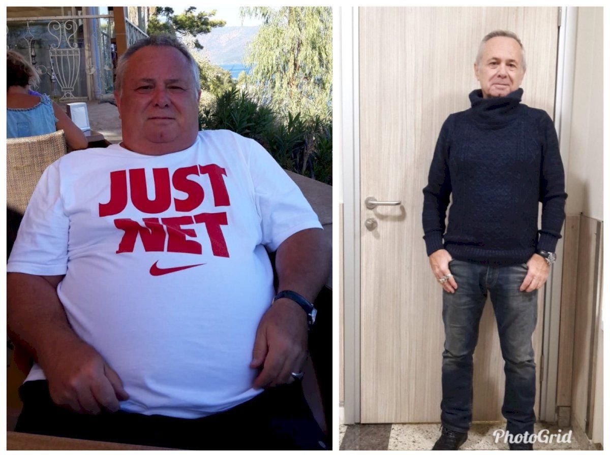 Before and after Da Vinci gastric sleeve surgery results at Hisar Hospital Intercontinental