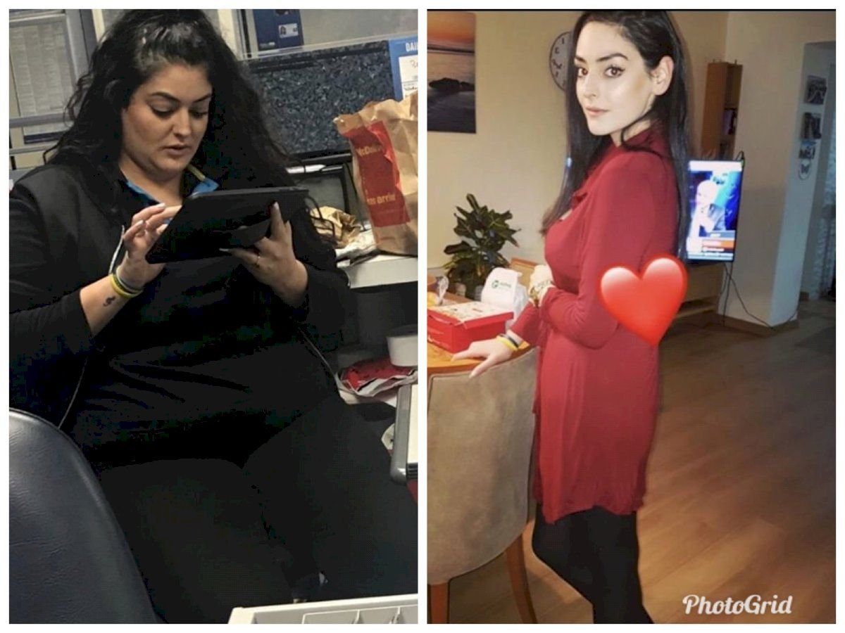 Before and after Da Vinci gastric sleeve surgery results at Hisar Hospital Intercontinental