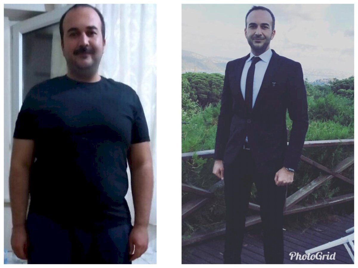 Before and after Da Vinci gastric sleeve surgery result at Hisar Hospital Intercontinental