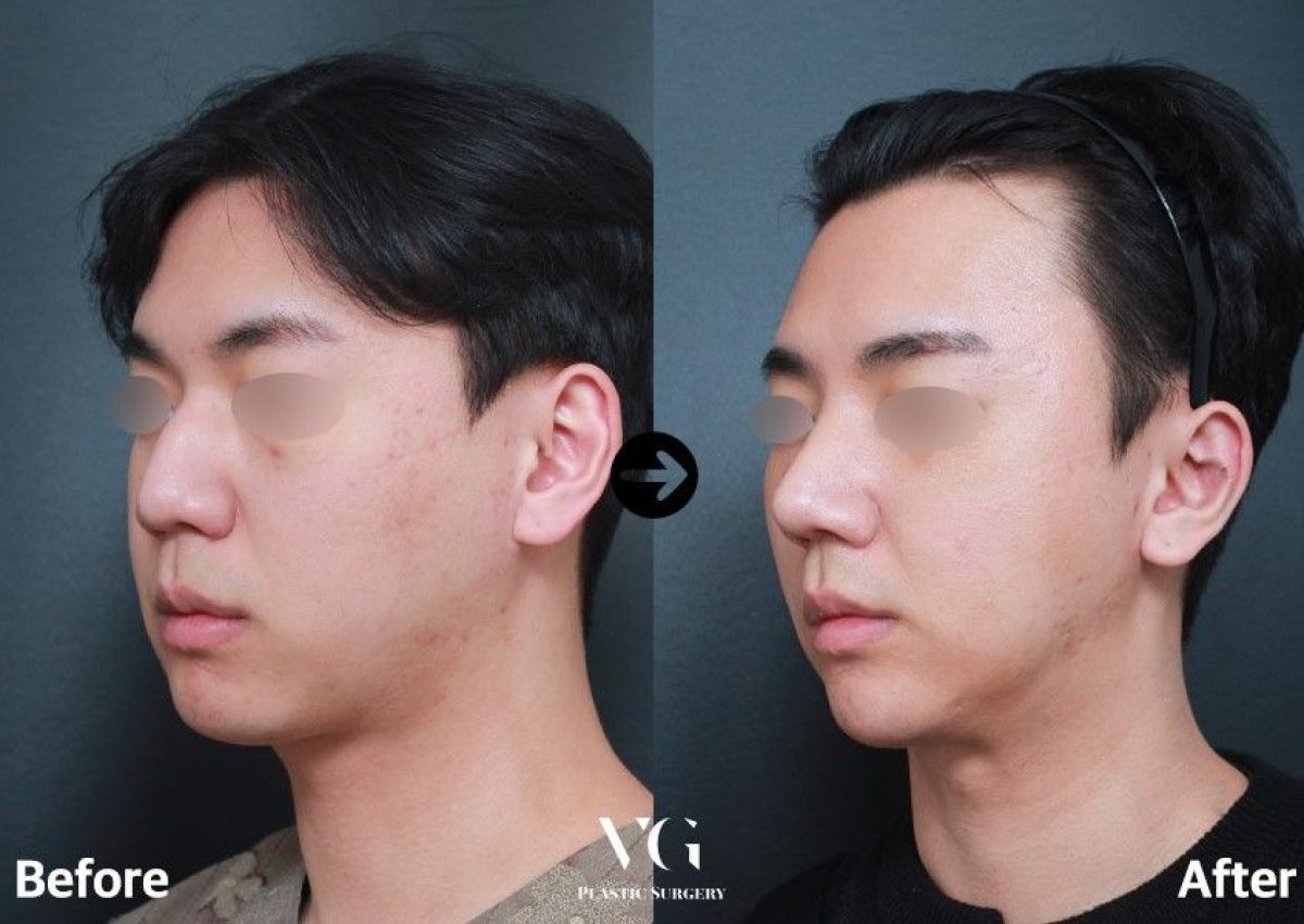 Vorher-nachher-Ergebnis der Revisionsrhinoplastik bei VG Plastic Surgery, verbesserte Nasenkontur
