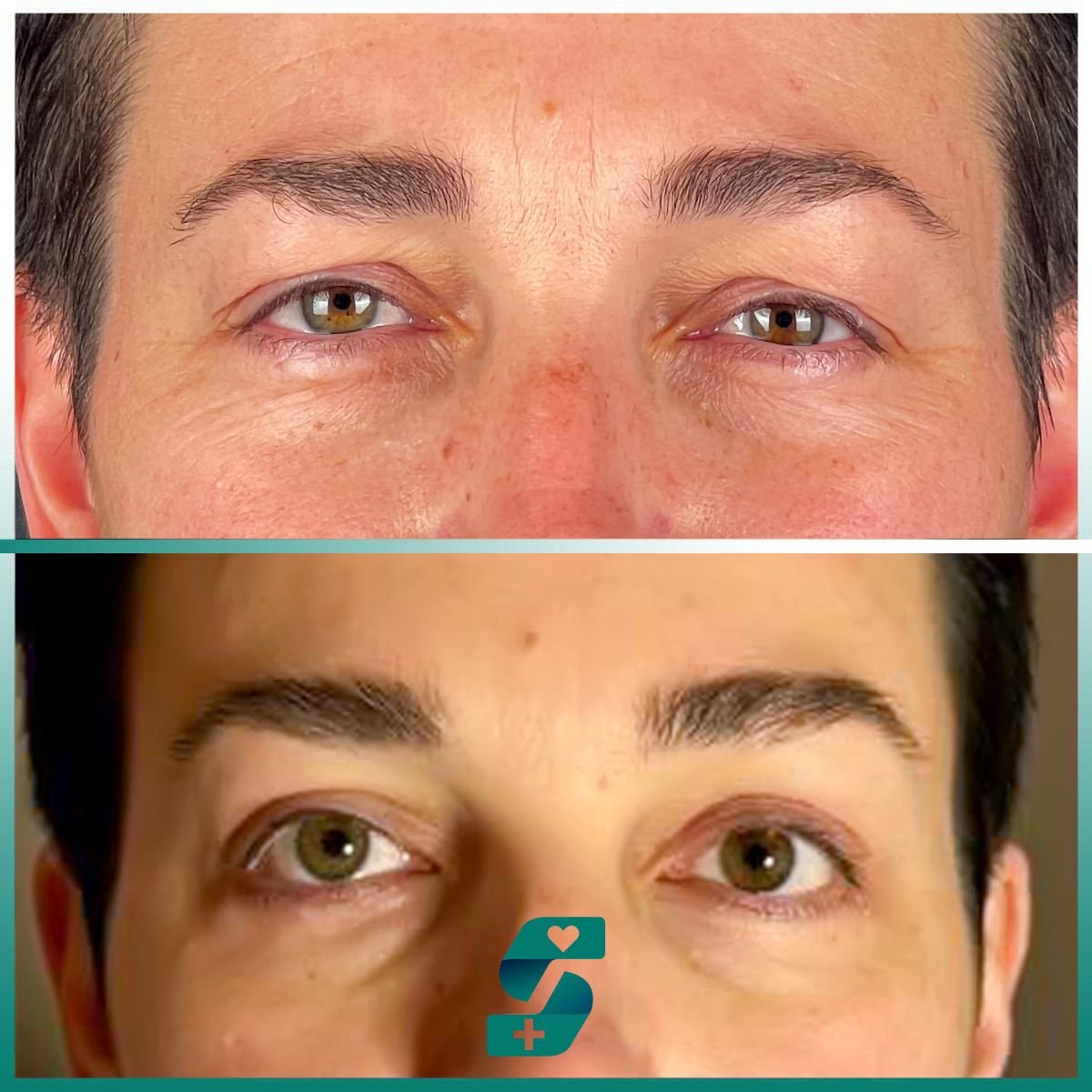 Resultados de blefaroplastia antes y después en Soraca Med Istanbul, corrección de párpados