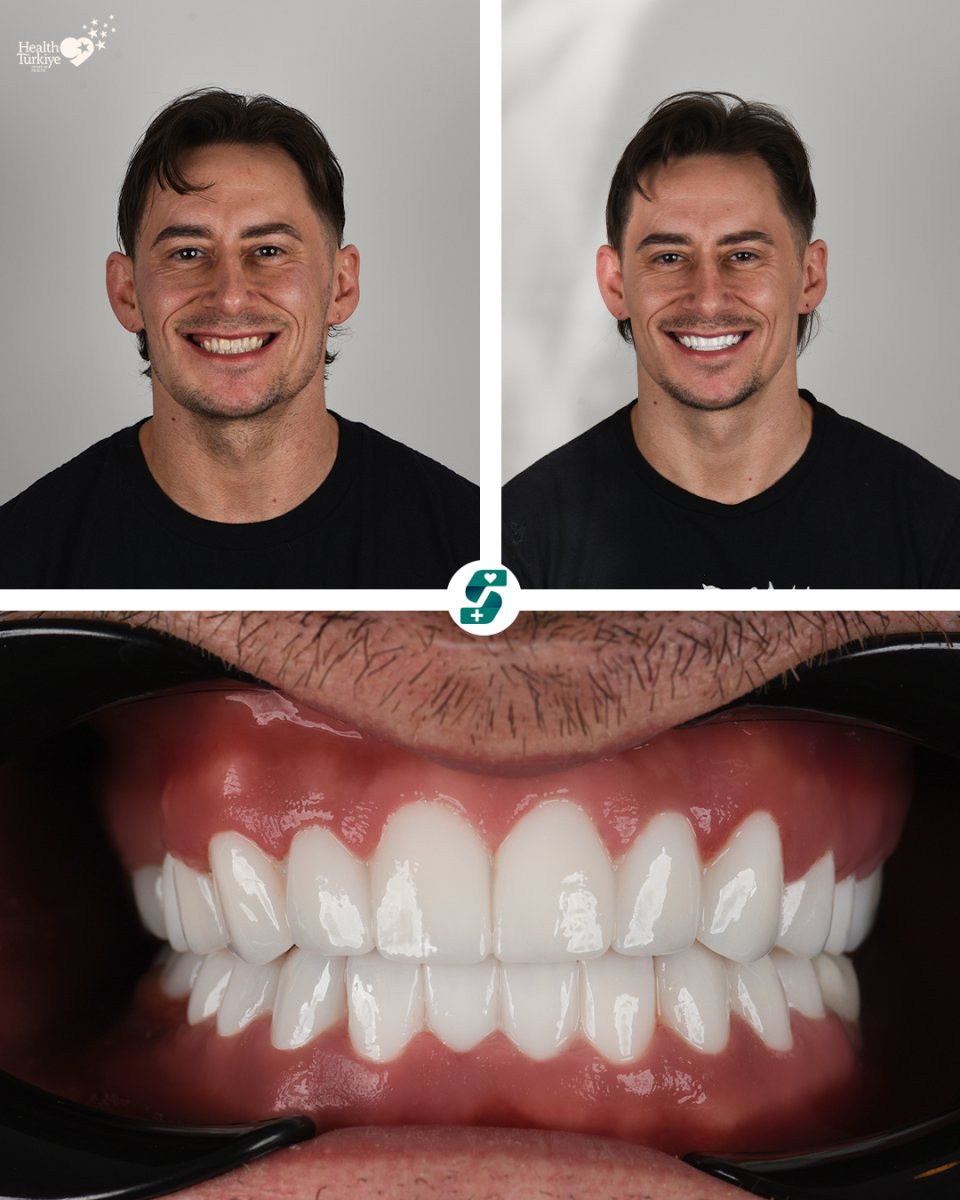 Before and after zirconia crown installation at Soraca Med, smile makeover results