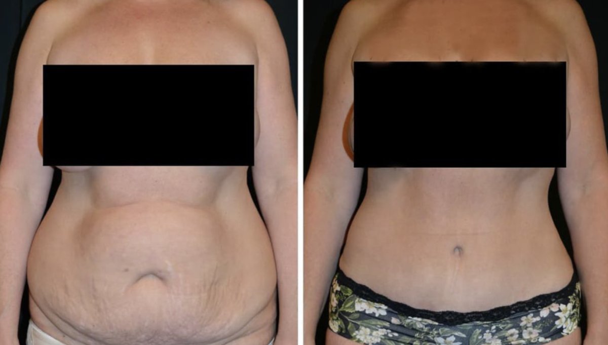 Résultats avant et après liposuccion chez Esthétique du Nord, amélioration du contour abdominal