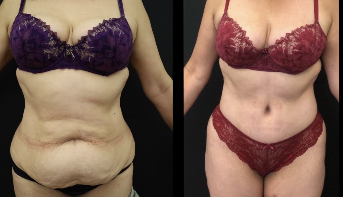 Résultats avant et après liposuccion chez Esthétique du Nord, contour abdominal amélioré