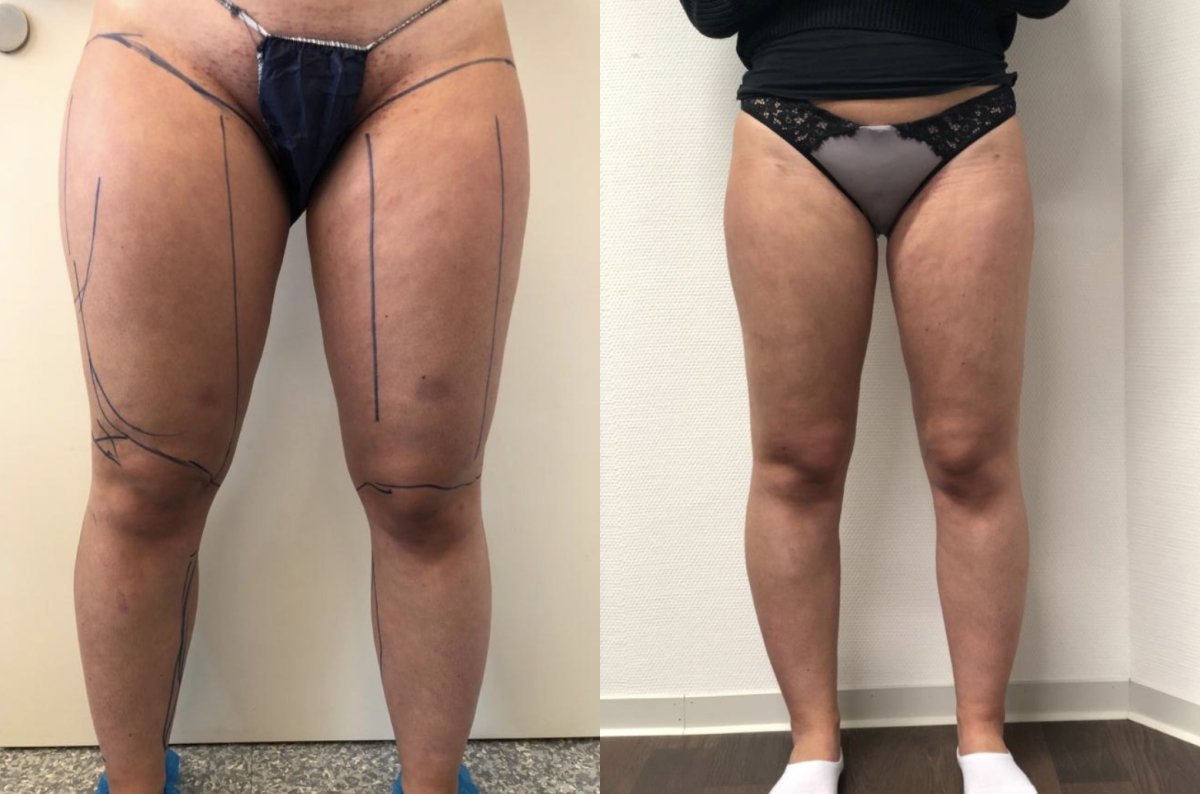 Resultados de liposucción antes y después en Esthétique du Nord, muslos más delgados
