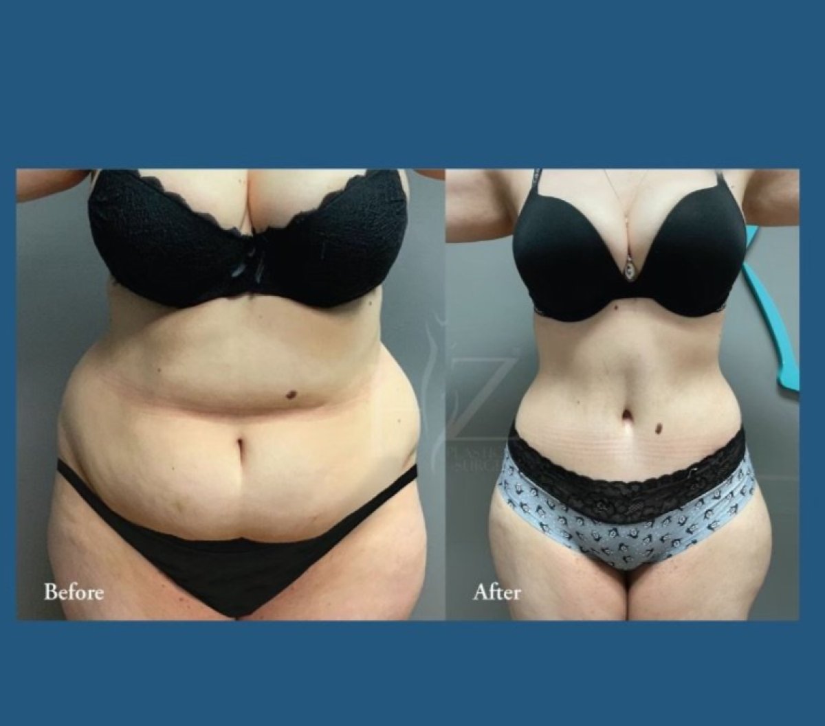 Before and after tummy tuck results at ID Clinic Bangkok – visible abdominal contour improvement