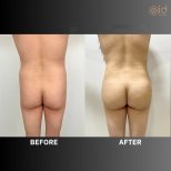 Before and after Brazilian Butt Lift photos by Dr. Dr Phatcharasak Kraisornphongsakul Md