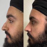 Before and after Rhinoplasty (nose job) photos by Dr. Marco Tulio Marroquin Batres