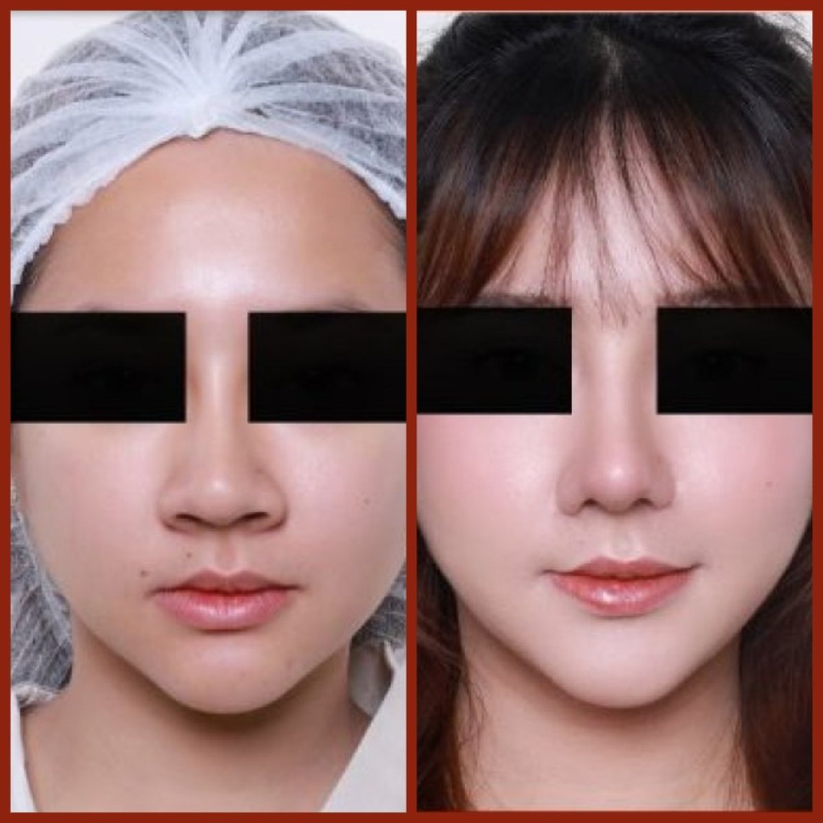 Resultados antes y después de rinoplastia asiática en DGB Clinic, nariz de aspecto natural