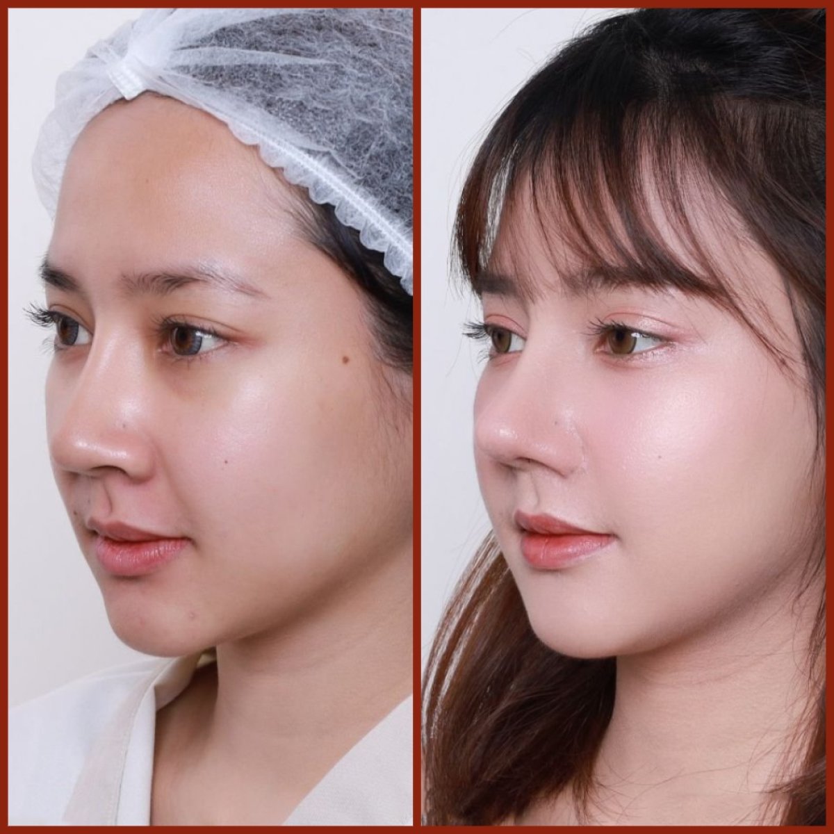 Before and after Asian rhinoplasty results at DGB Clinic, nose reshaping with natural look