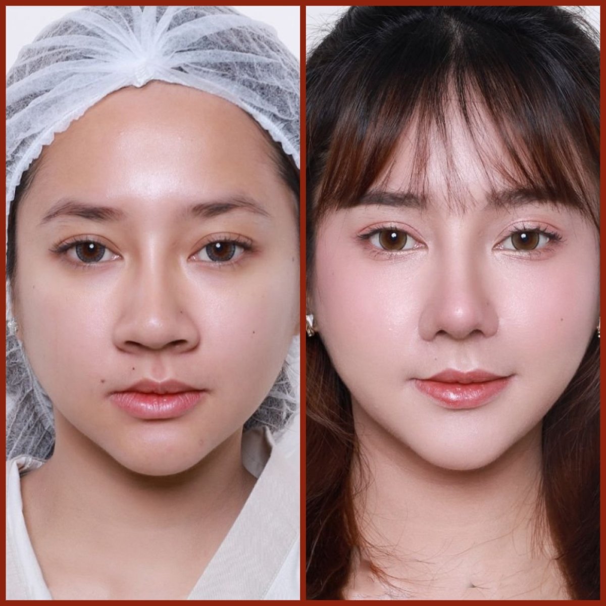 Resultados antes y después de rinoplastia asiática en DGB Clinic, nariz de aspecto natural
