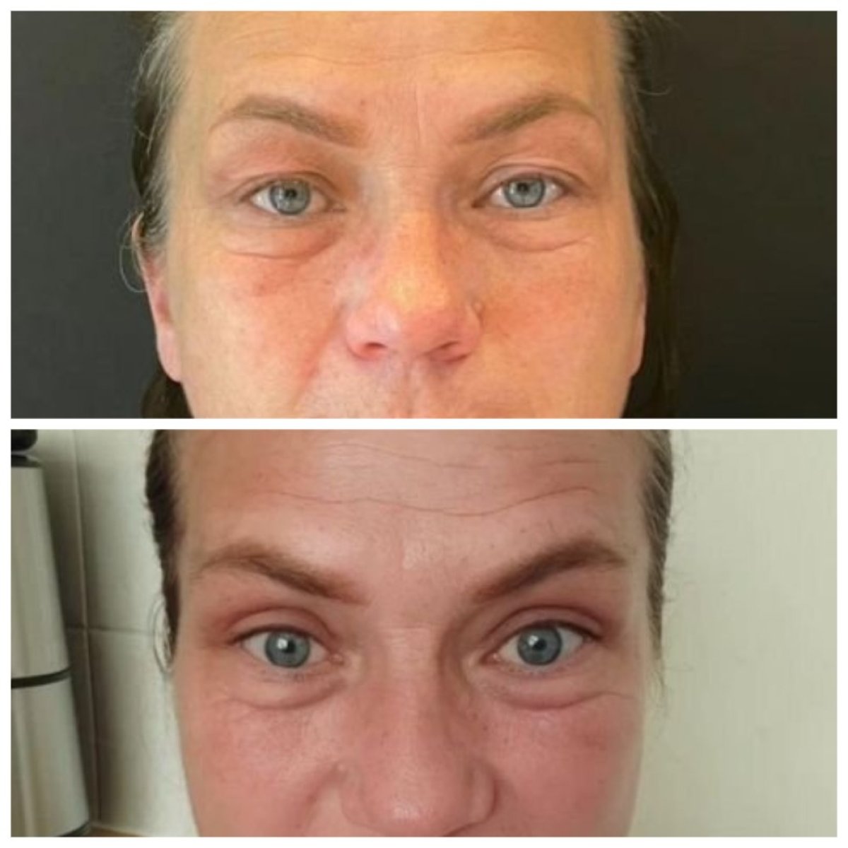 Resultados de blefaroplastia antes y después en Soraca Med Istanbul, corrección de párpados