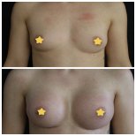 Before and after Breast augmentation photos by Dr. 