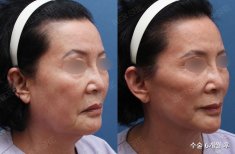 Fotos vor und nach Facelift durch Dr. 