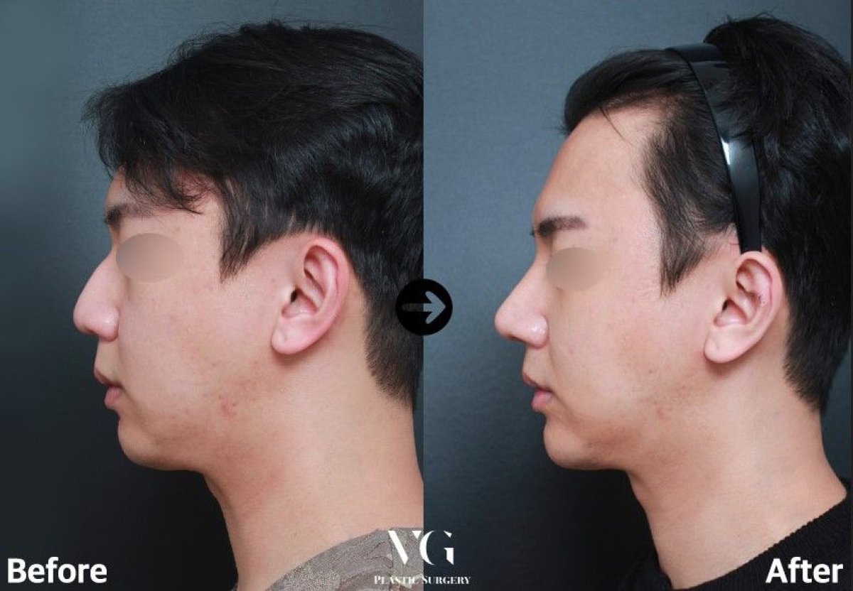 Résultats avant et après rhinoplastie chez VG Plastic Surgery, profil nasal amélioré chez homme