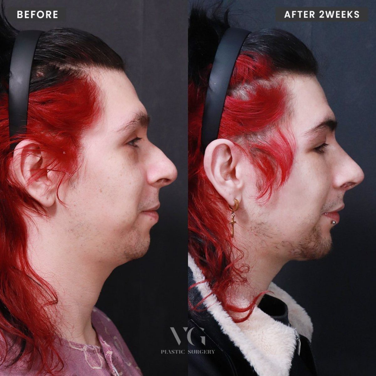Resultados de rinoplastia antes y después en VG Plastic Surgery, perfil nasal mejorado tras 2 semanas