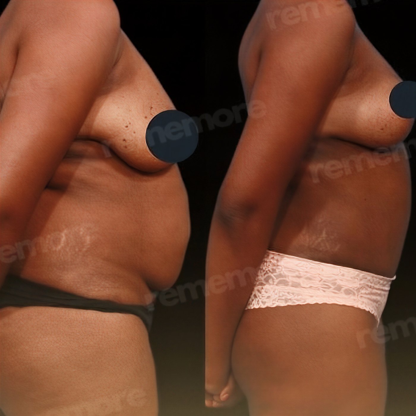 Resultados antes y después de mommy makeover en Memorial Göztepe Hospital, mejor contorno corporal