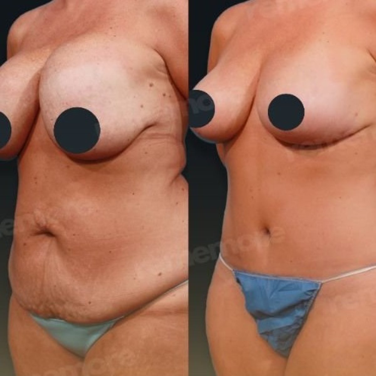 نتائج قبل وبعد عملية تجميل الأم في مستشفى ميموريال غوزتيبي، تحسين شكل الجسم