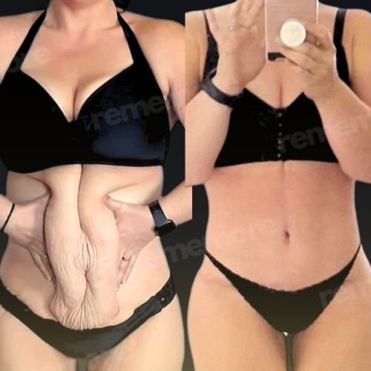 Résultats avant/après mommy makeover à Memorial Göztepe Hospital, ventre remodelé