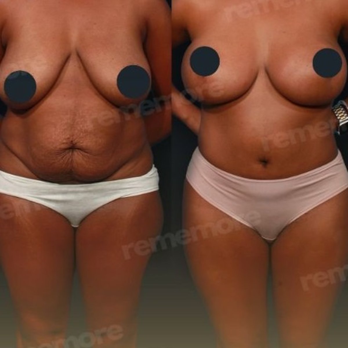Mommy makeover before and after results at Memorial Bahçelievler Hospital, body contouring