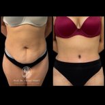 Fotos vor und nach Fettabsaugung am Bauch durch Dr. Cemal Firat